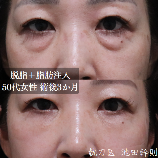 目の下のふくらみ部分の皮膚のハリが弱い場合は、とくに眼窩脂肪の取りすぎに注意が必要です