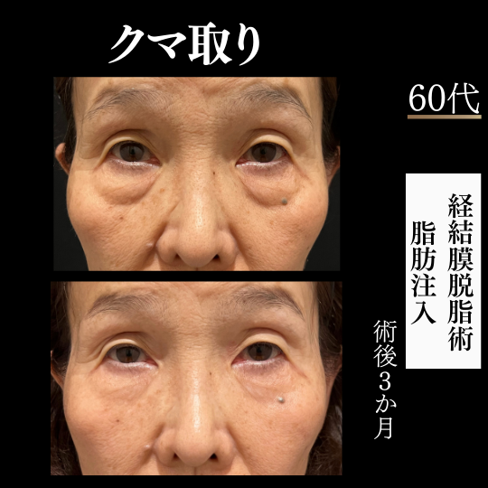 60代女性　脱脂＋脂肪注入　術後3か月