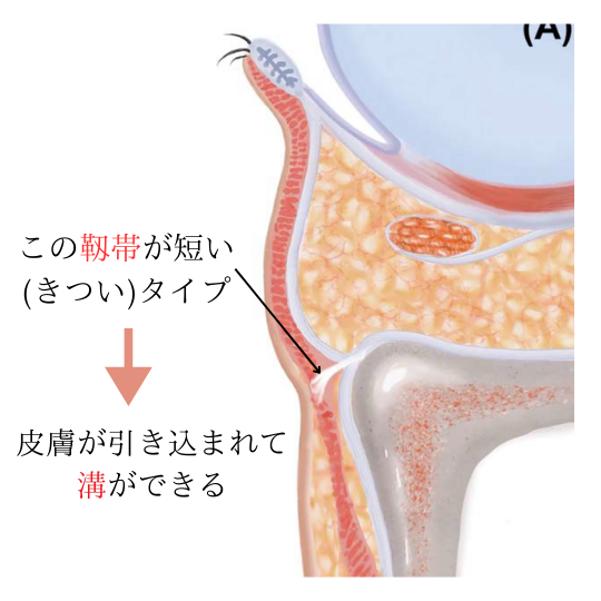 裏ハムラ法と目の下の溝