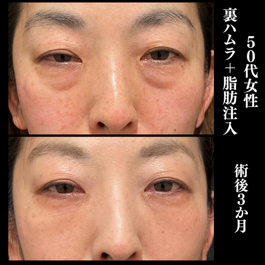 皮膚のハリが低下が強い人は、裏ハムラに脂肪注入を追加する