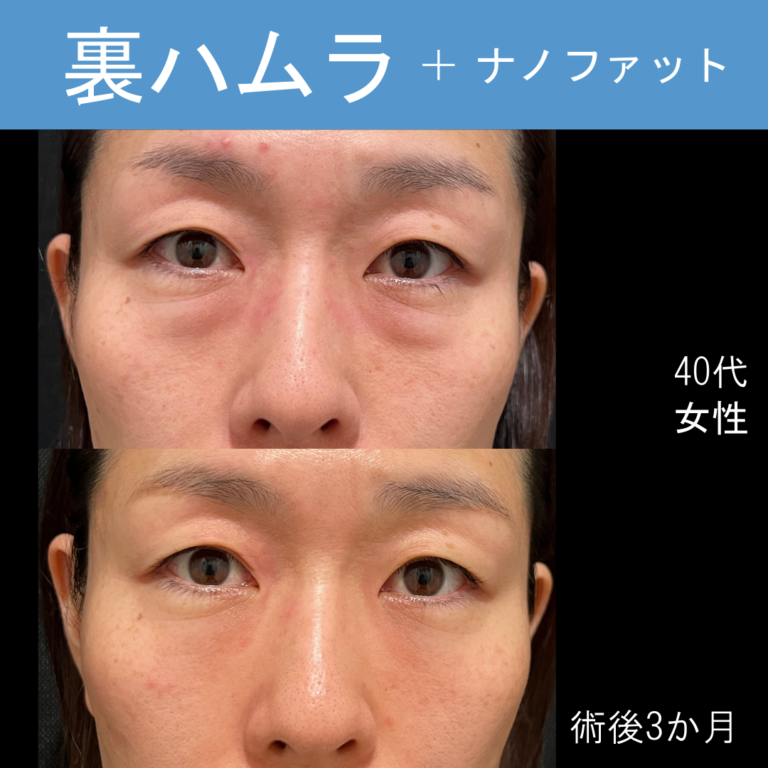 裏ハムラにナノファット併用でシワも改善！