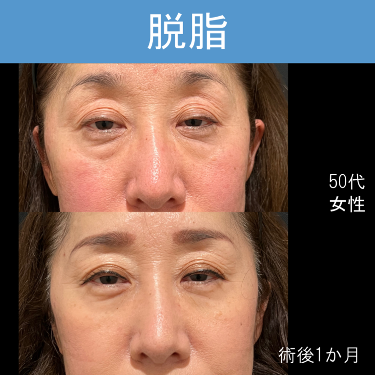 50代女性　経結膜脱脂術のみ　術後1か月