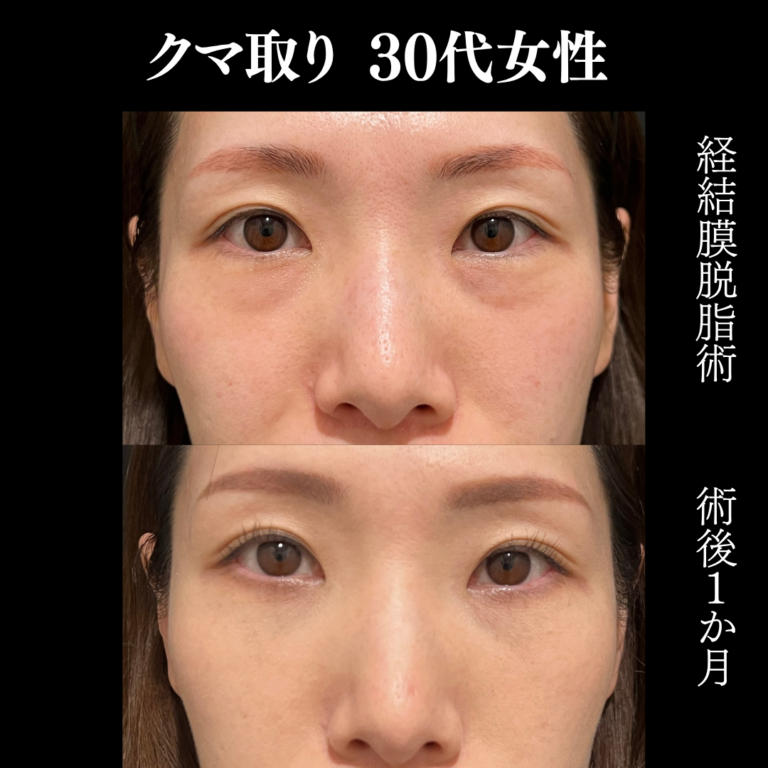 30代女性　経結膜脱脂術のみ　術後1か月