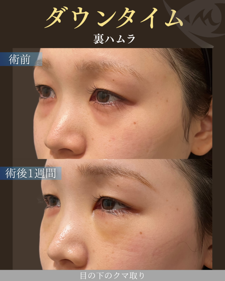 20代女性　裏ハムラ　ダウンタイム