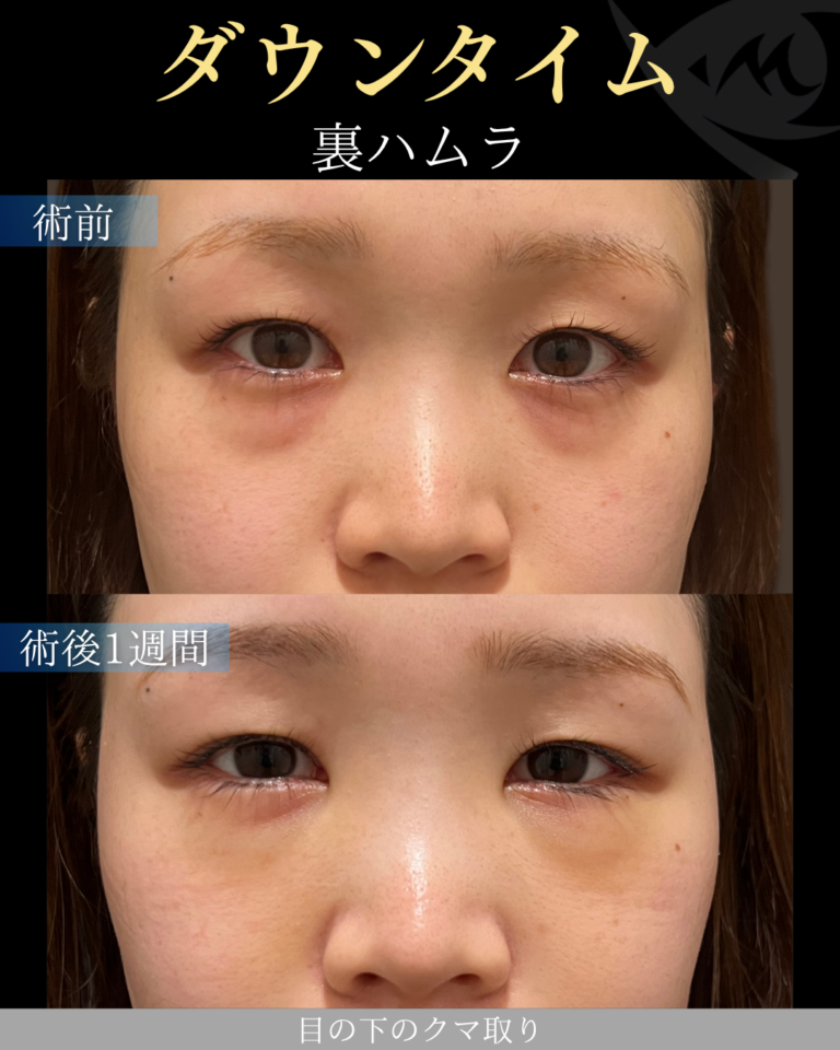 20代女性　裏ハムラ　ダウンタイム