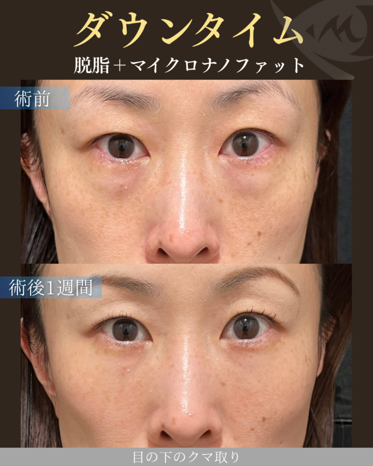 40代女性 脱脂＋マイクロナノファット ダウンタイム