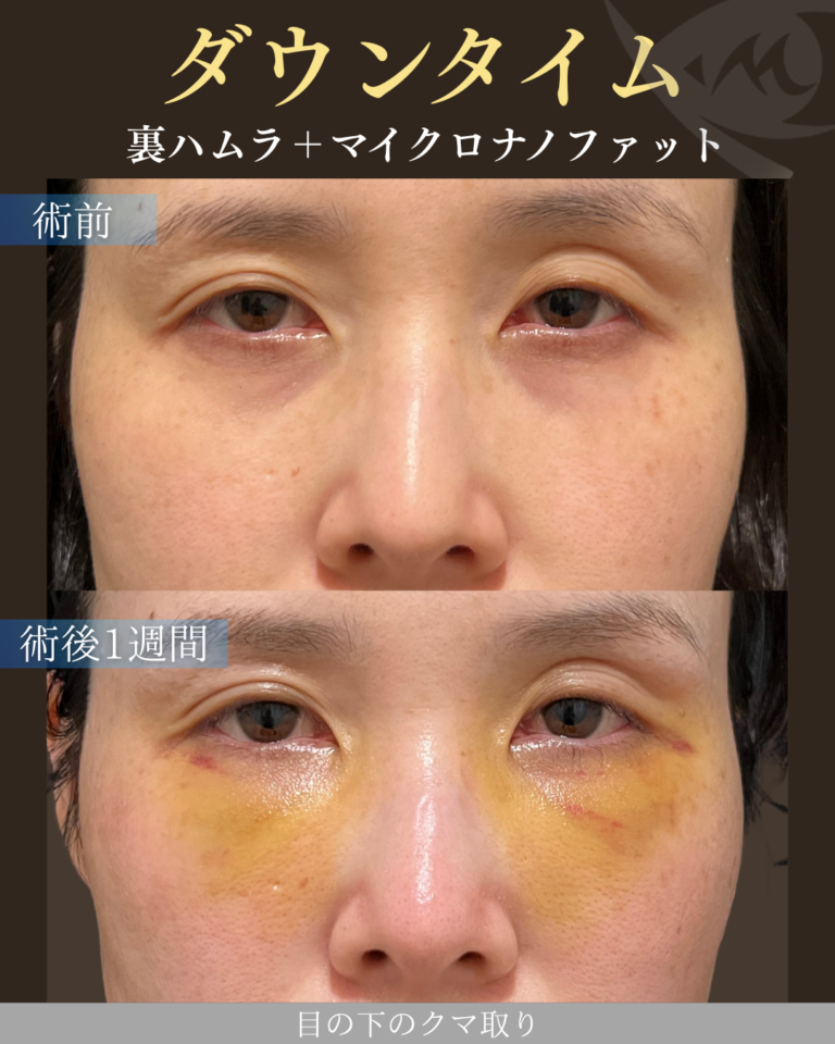 30代女性 裏ハムラ＋マイクロナノファット ダウンタイム