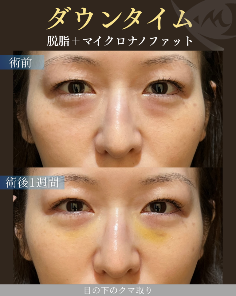 30代女性 脱脂＋マイクロナノファット ダウンタイム