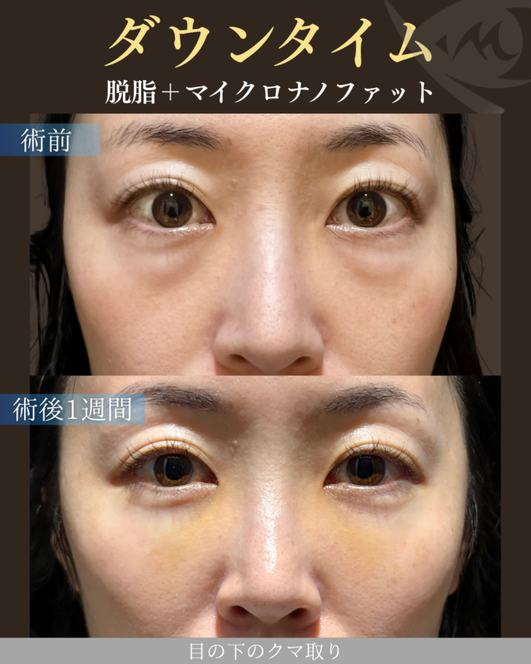30代女性 脱脂＋マイクロナノファット ダウンタイム
