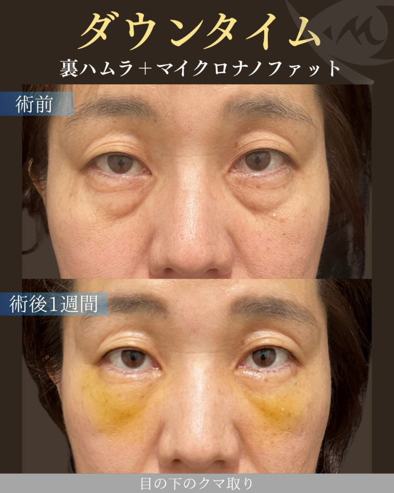 50代女性 裏ハムラ＋マイクロナノファット ダウンタイム