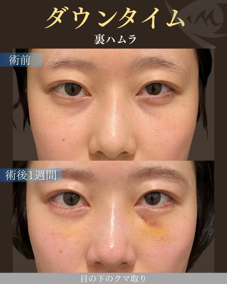 20代女性 裏ハムラ ダウンタイム