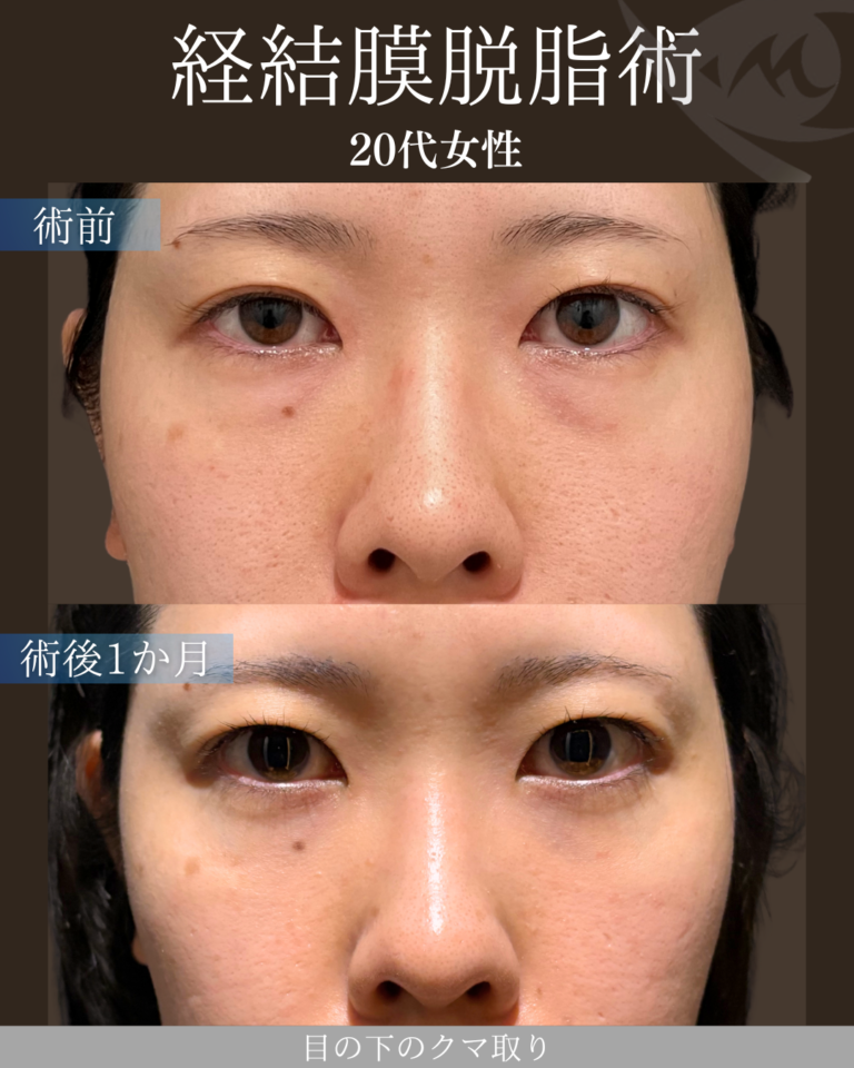 20代女性 経結膜脱脂術 術後1ヶ月