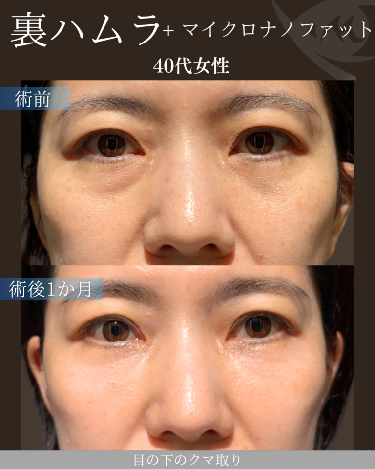 40代女性 裏ハムラ＋マイクロナノファット 術後1ヶ月