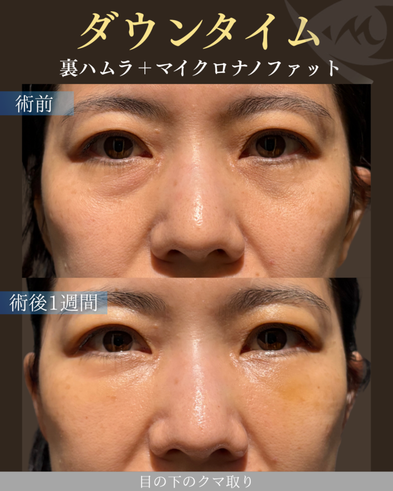 40代女性 裏ハムラ＋マイクロナノファット ダウンタイム