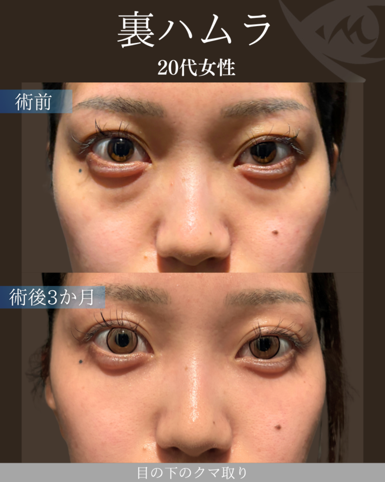20代女性 裏ハムラ 術後3ヶ月