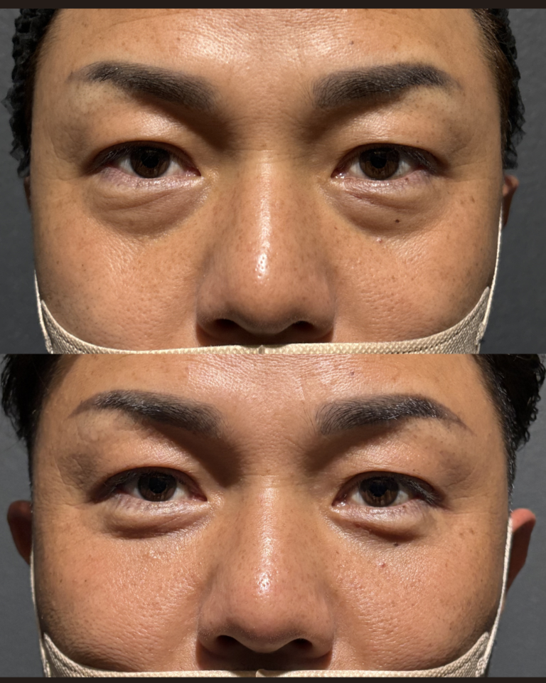 男性の深いティアトラフは裏ハムラ法で解決