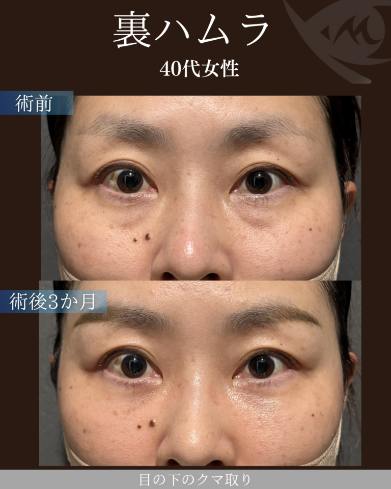 40代女性　裏ハムラ法