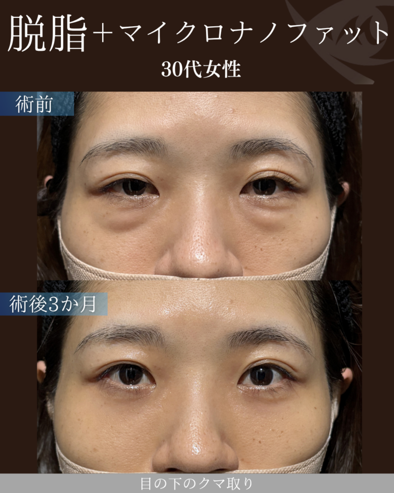 30代女性　脱脂+マイクロナノファット