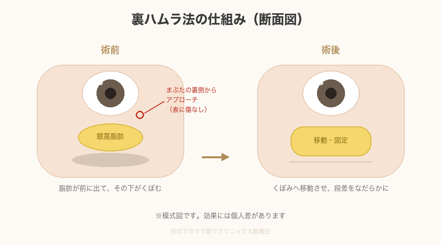 裏ハムラ法の仕組み 断面図