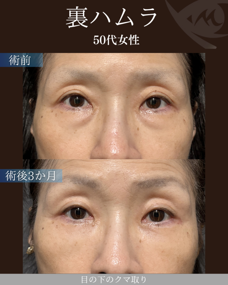 50代女性　裏ハムラ法