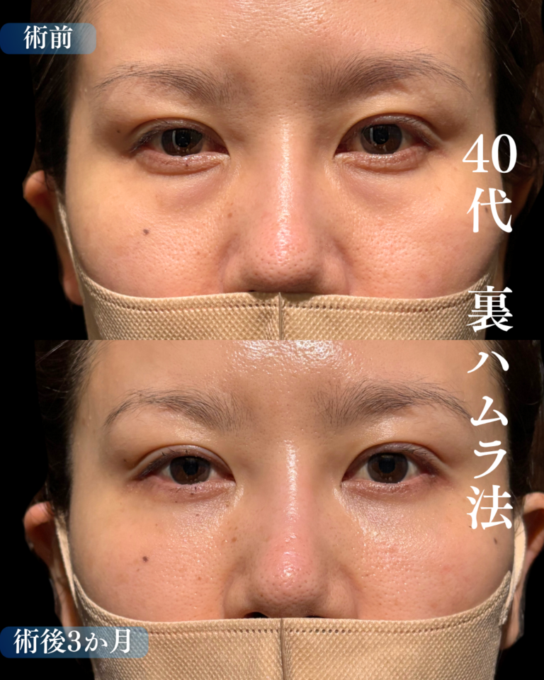 40代女性　裏ハムラ法
