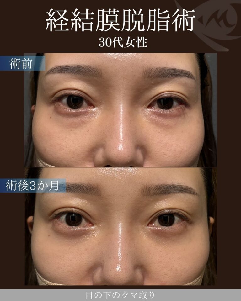 30代女性　経結膜脱脂術