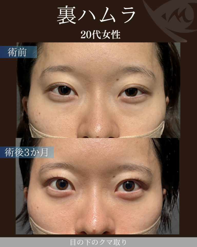 20代女性　裏ハムラ法