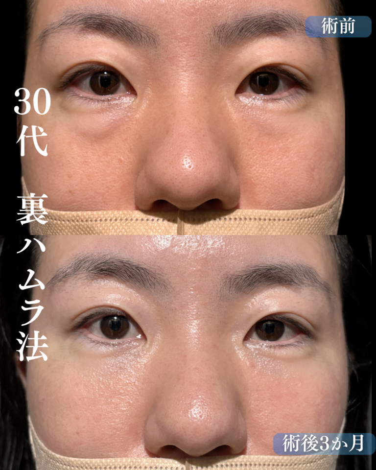 30代女性　裏ハムラ法