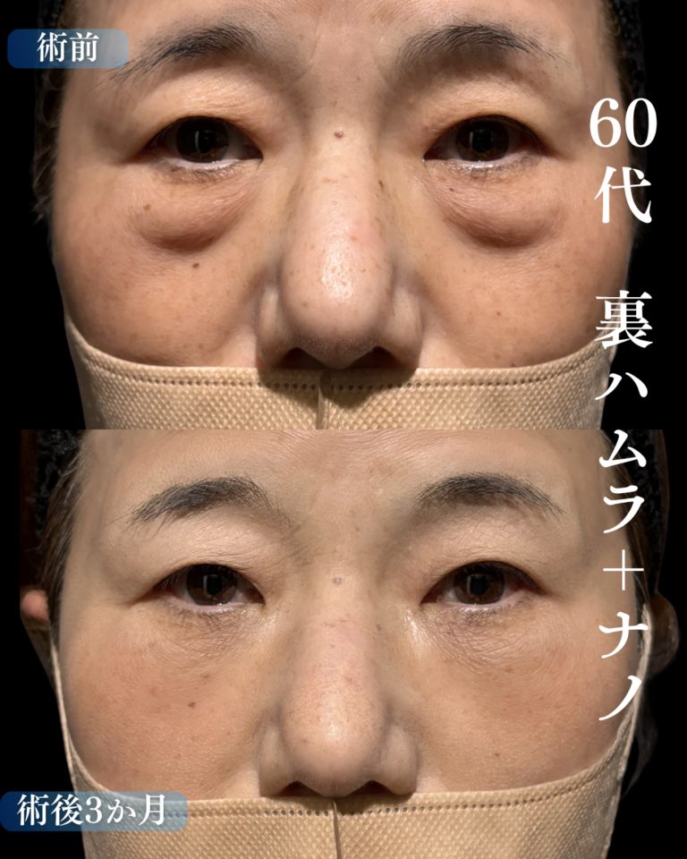 60代女性　裏ハムラ法+脂肪注入